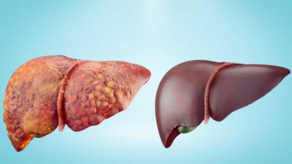 best way to detox your liver naturally, foods that cleanse liver naturally