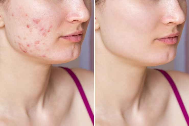 how to remove pimples,
9 natural ways to get rid of pimples at home