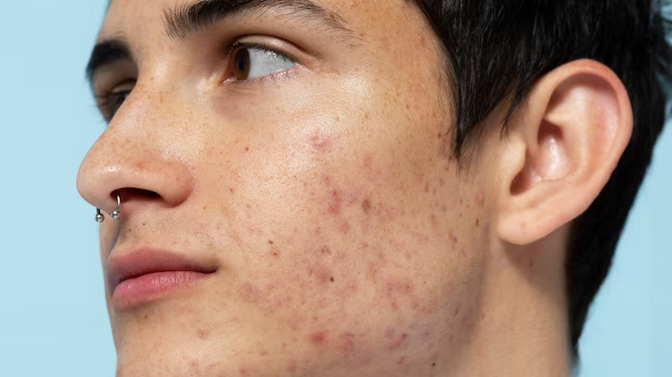 how to remove pimples,
9 natural ways to get rid of pimples at home