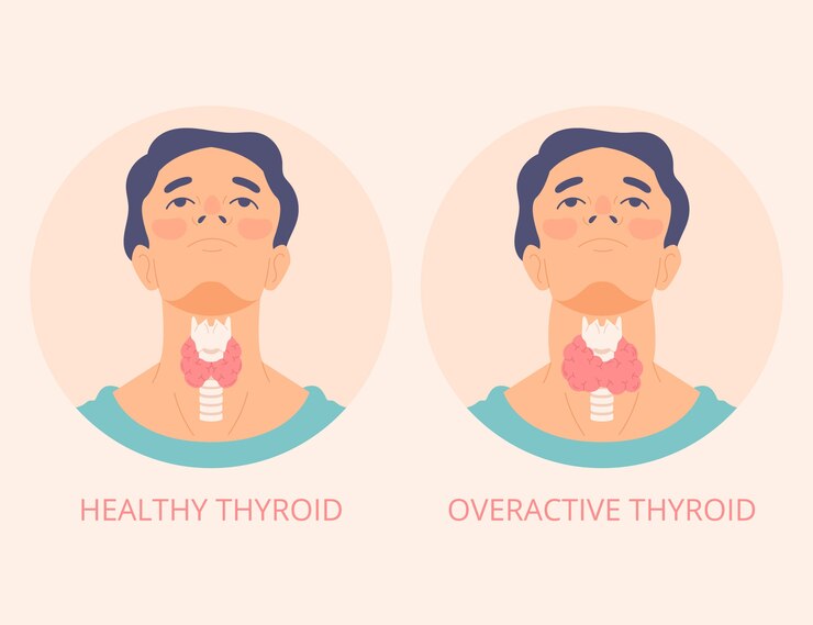 Thyroid Diet Chart | Most Effective Diet for Thyroid