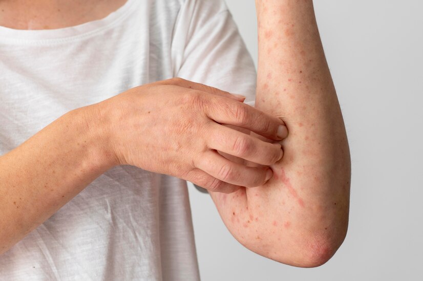 How can I stop Eczema Itching Problem 