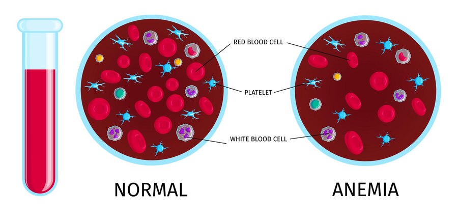 How to treat Anemia