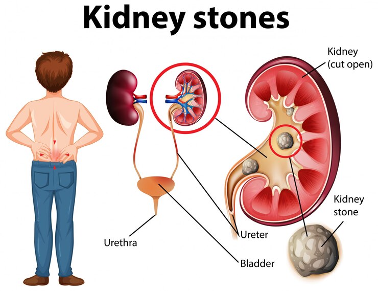 How to Remove Kidney Stone Naturally With Home Remedy
