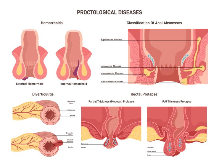 How To Treat Piles At Home | Hemorrhoids - Symptoms and causes