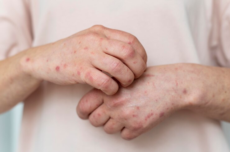 How do I get rid of psoriasis fast